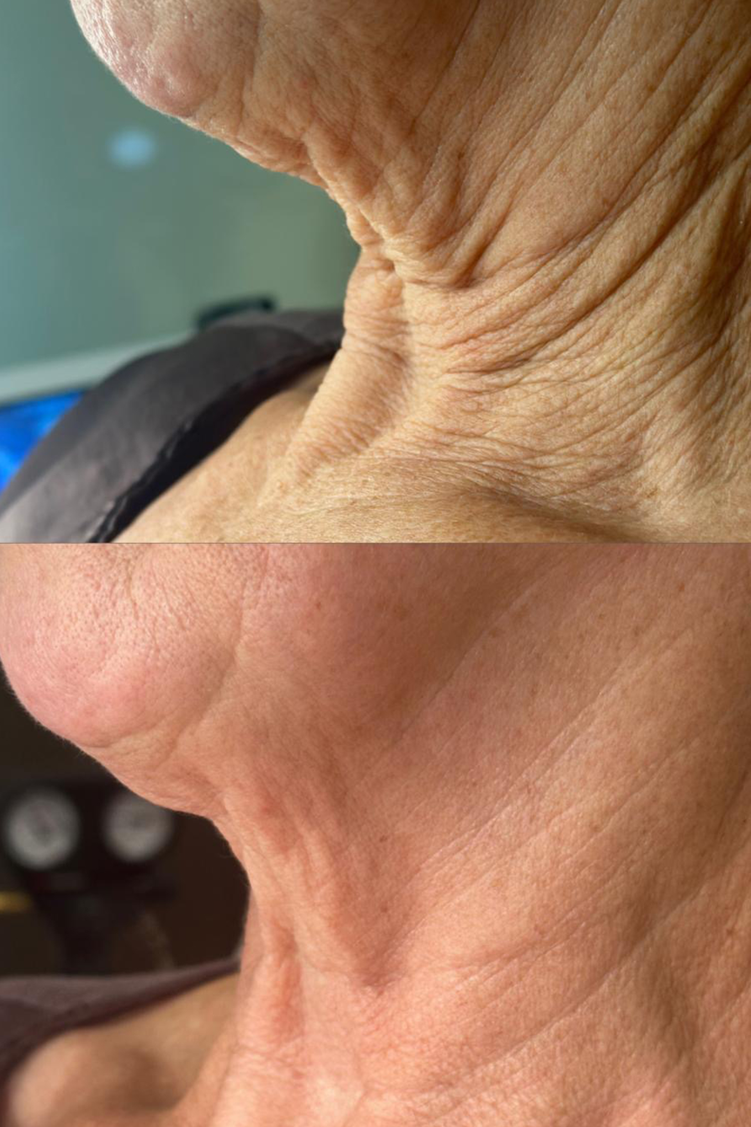 Fusion plasma hals lift