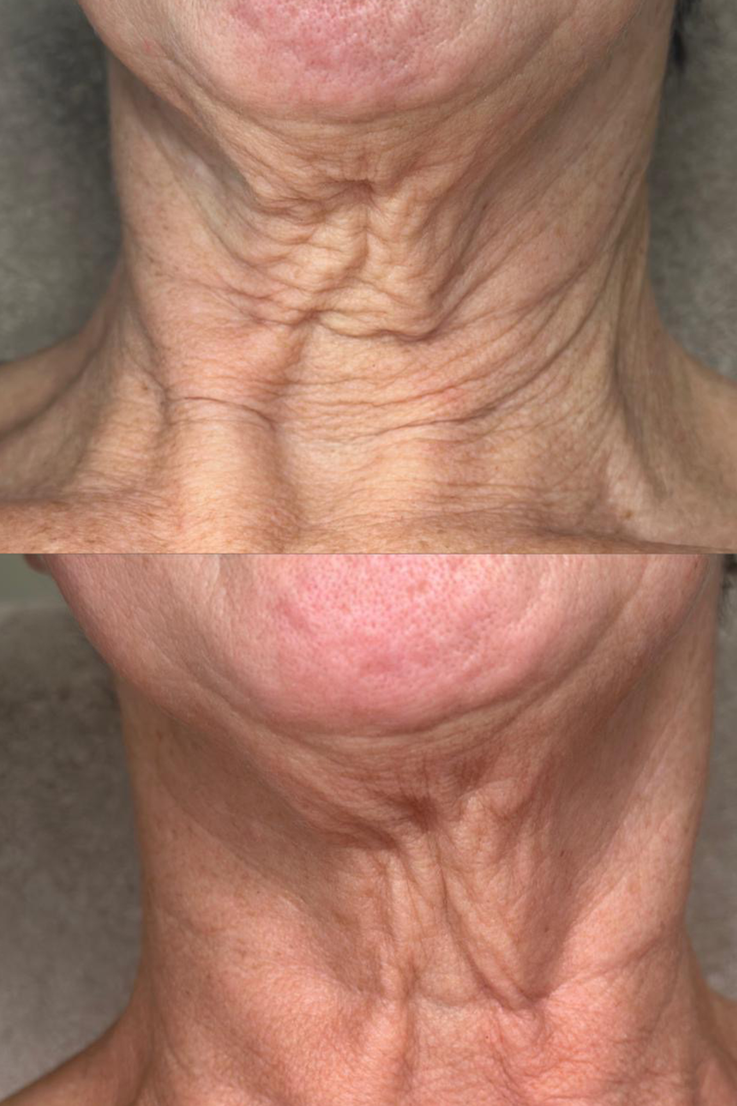 Fusion plasma hals lift